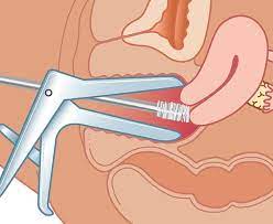 Picture showing how pap smear is done